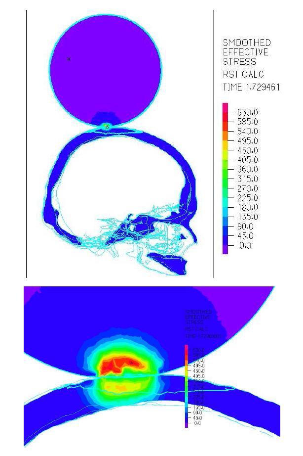 The simulation results of effective stress on the skull and ice mass contact region