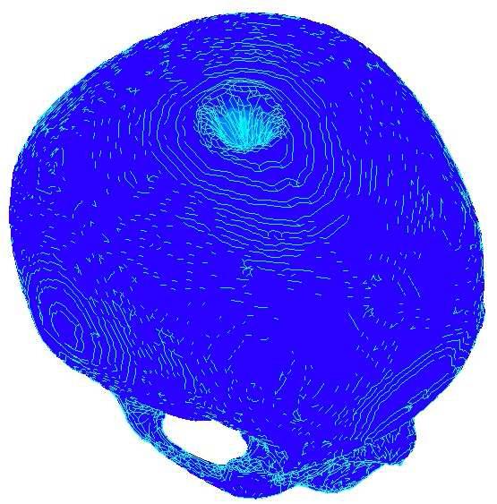 The distorted and broken deformation of the skull