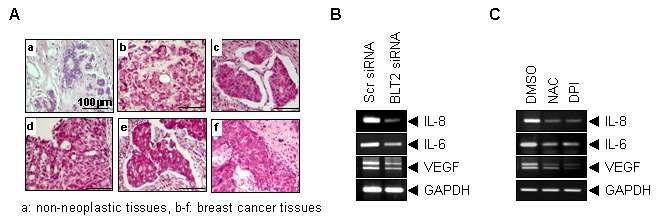 유방암 환자 조직에서의 BLT2 과발현과 pro-tumorigenic cytokine생성과의 연관성