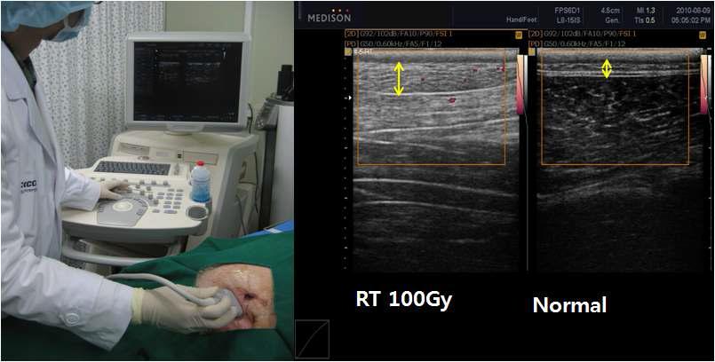 국소 조사 부위 sonography