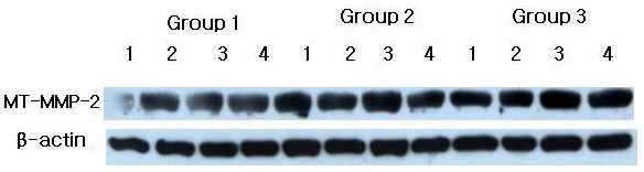 MT-MMP-2 western blot analysis showing 4 representative samples in each group. MT-MMP-2 levels were quantified on the basis of β-actin levels. MT-MMP-2 corresponding to molecular weight 64 kD was shown to be expressed in all samples including healthy gingiva. The expression levels of MT-MMP-2 increased in order of Group 1, Group 2 and Group 3.