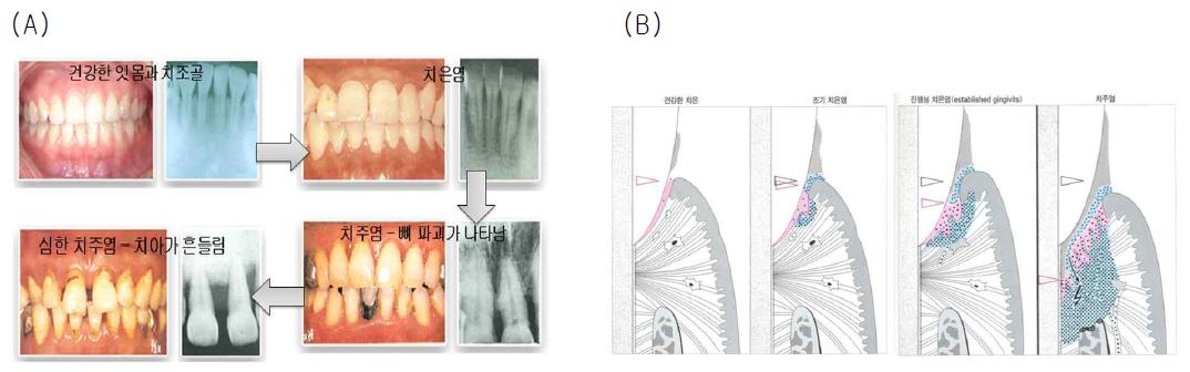 치주염으로 진행과정 : 치주질환의 초기 치은염에서 후기 치주염으로 발전함에 따라 치아의 지지조직이 약해짐.