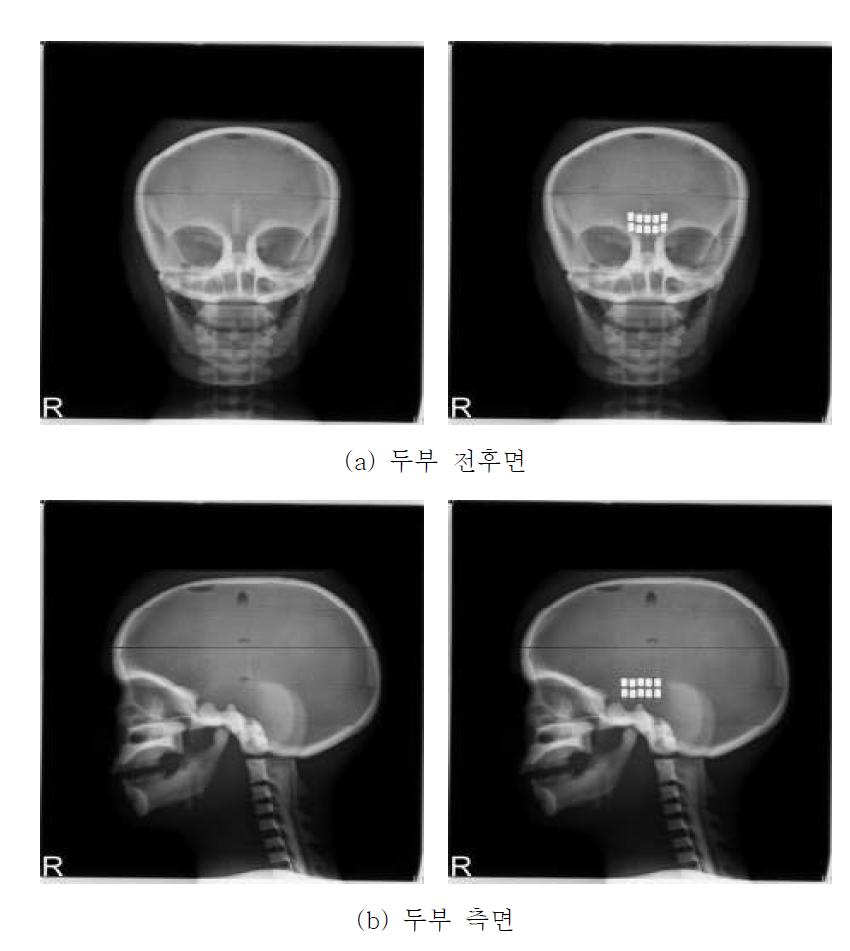 두부 엑스선 촬영 영상