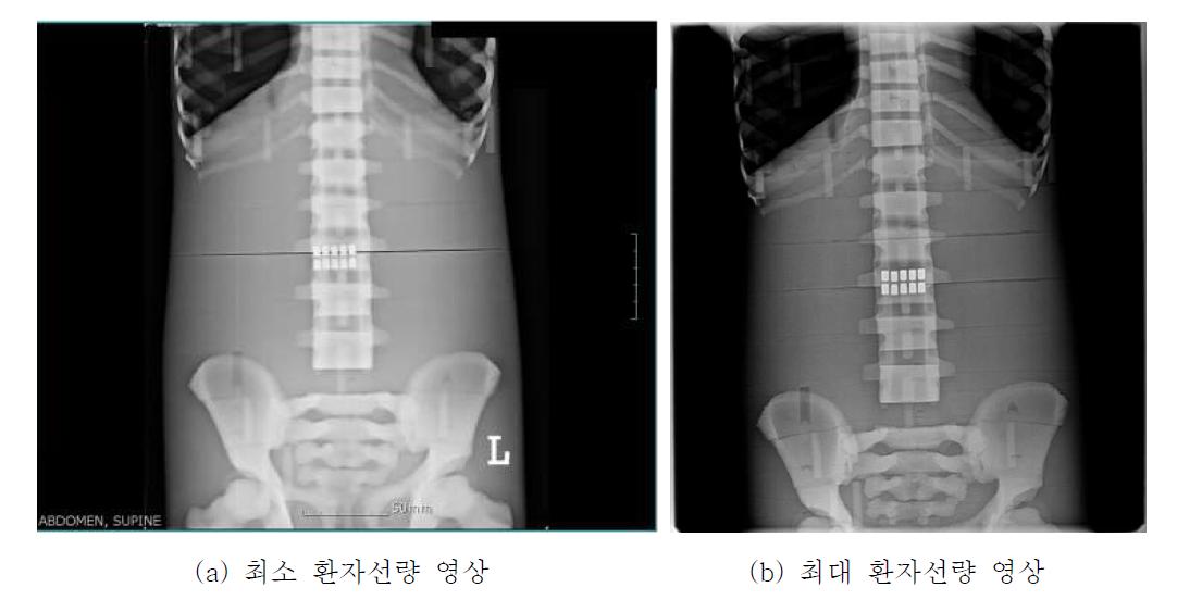 복부 전후면 엑스선 촬영 영상 비교