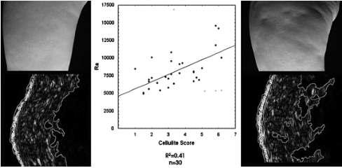셀룰라이트의 디지털 이미지와 초음파 이미지 및 score과의 상관성