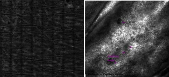 (좌) 공초점 현미경 촬영 이미지 (60um), (우) 피부 진피층 이미지