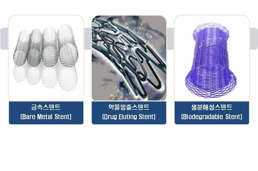 형상 및 디자인에 따른 스텐트의 구분