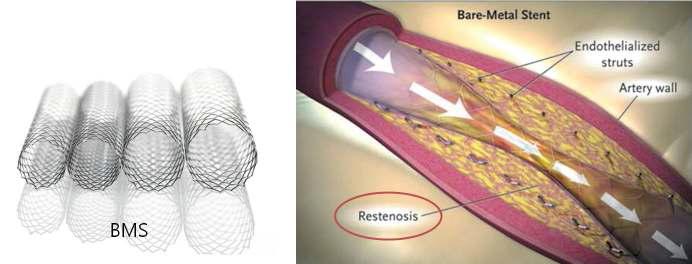 재협착(restenosis) 모식도