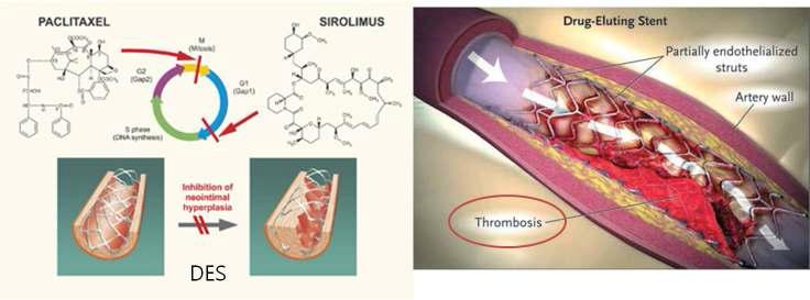 약물방출스텐트의 약물 작용과 혈전증(Thrombosis)의 모식도