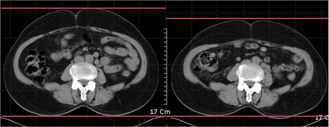 치료 전 후 복부비만도 CT 변화