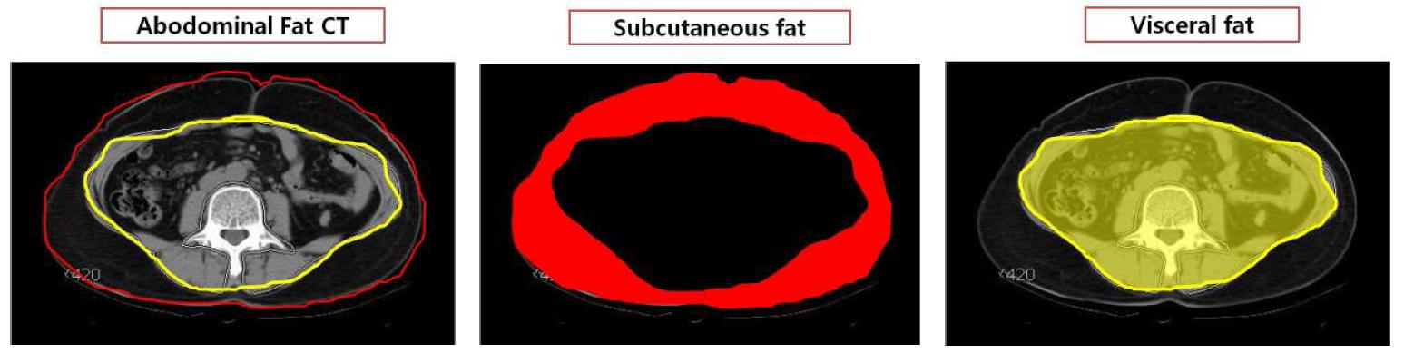 Measurement of abdominal fat, visceral fat, and subcutaneous fat.