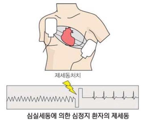 자동제세동기의 원리