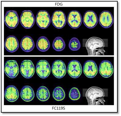 FC119S의 PET 영상 자료: 임상시험 효과 및 성능 평가