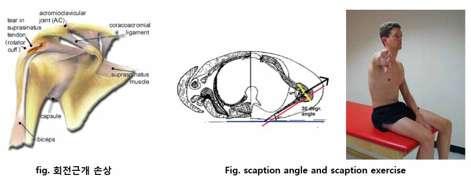 그림 171. 회전근개 손상과 재활운동 방법