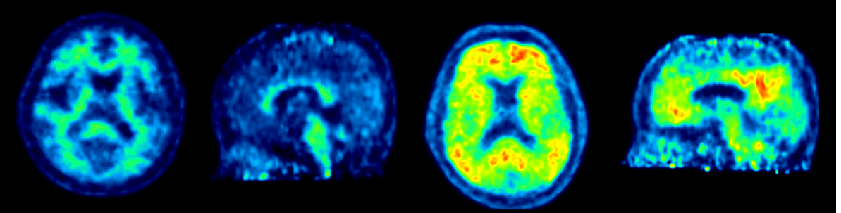 치매환자의 Aβ amyloid 영상용 분자영상 의약품을 이용하여 얻은 PET 영상