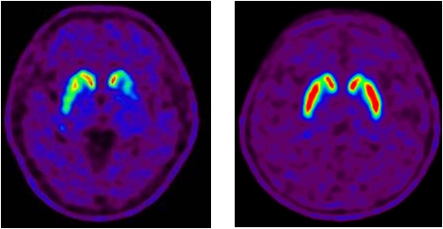 정상인과 파킨슨병 환자에서 도파민운반체 PET영상