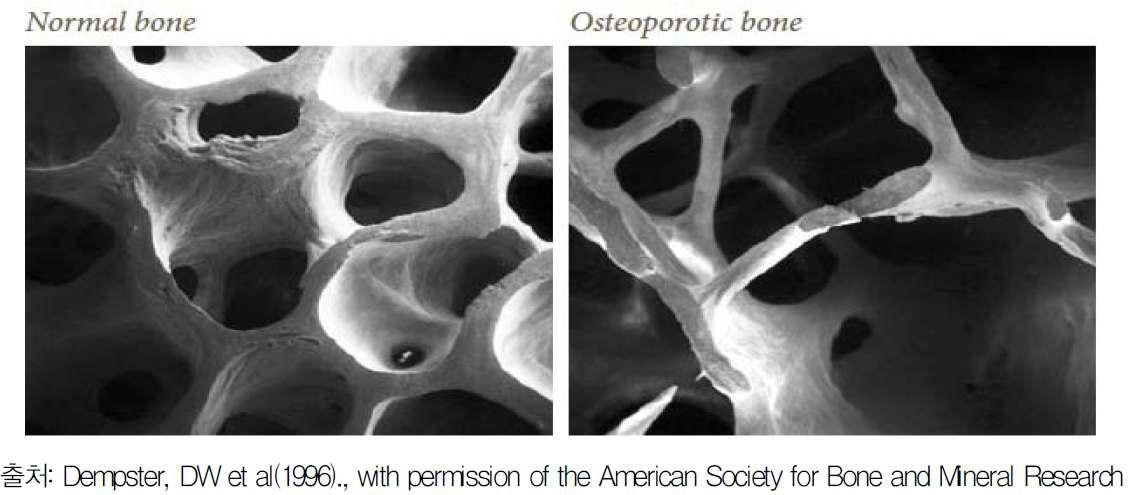 정상(normal) 뼈 상태 vs 골다공증 뼈 비교