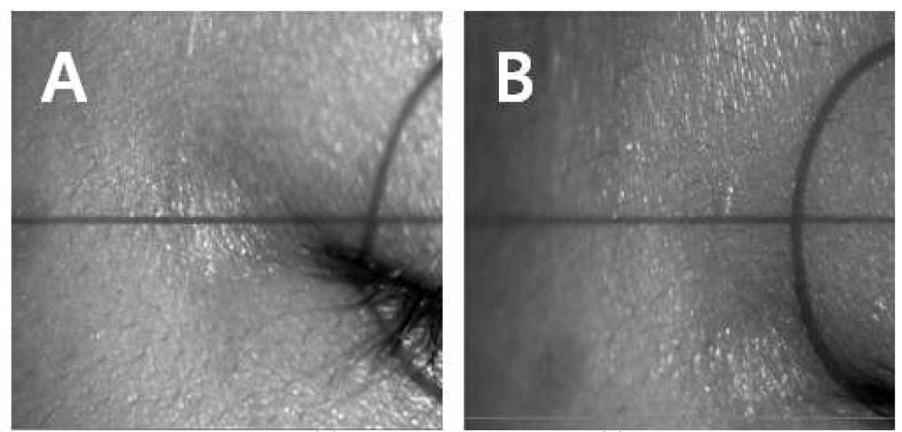 Eye winkles before (A) and at 4 weeks after (B) topical application with the MME cream formulation containing Kaki Calyx extracts twice daily.