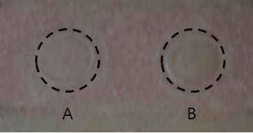 Photograph of human patch test of RDES