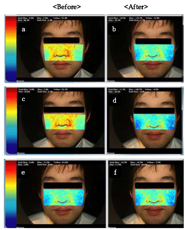 Photograph comparison of melanin analysis before and after treatment sample.