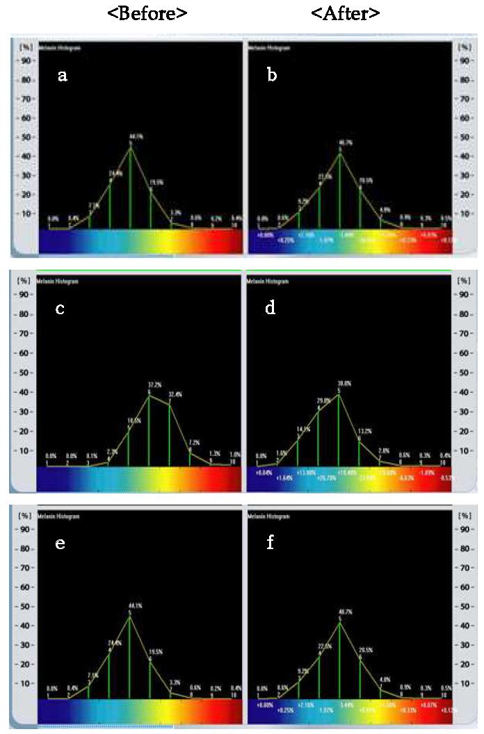 Photograph comparison of melanin histogram analysis before and after treatment sample.