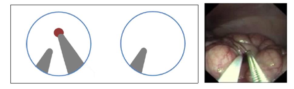 (a) 수술 영역이 내시경 카메라의 시야에서 벗어나는 경우, (b) In-line Vision Problem