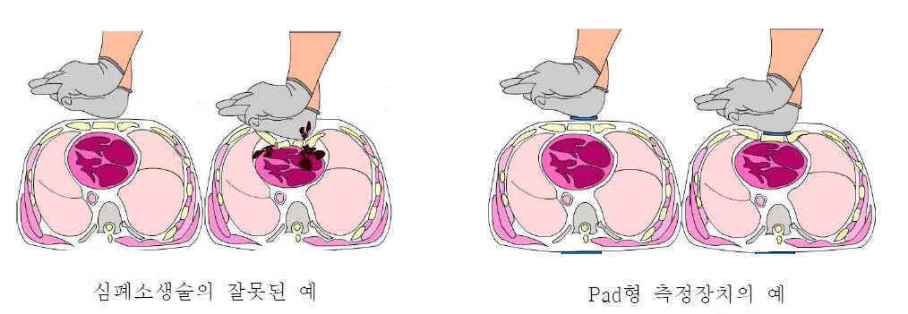 심폐 소생술의 적절한 사용 예시