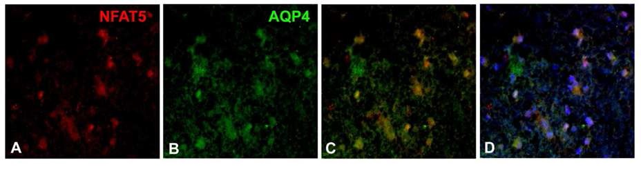 그림 10. NFAT5 and AQP4 expression in human mesial temporal lobe epilepsy.