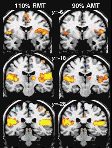 그림 5. 왼쪽 줄에 있는 그림은 resting motor threshold (RMT)의 110%로 rTMS를 가했을 때 형성되는 뇌 신경망이고, 오른쪽 줄에 있는 그림은 active motor threshold (AMT)의 90%로 rTMS를 가했을 때 형성되는 뇌신경망 (Bestmann et al., 2004). 그림의 왼쪽은 뇌의 오른쪽이고, 그림의 오른쪽은 뇌의 왼쪽임.