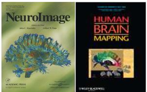 그림 7. (좌) 확산텐서 영상을 이용한 대뇌신경섬유. Park et al. 2003. 표지, (좌) 뇌량의 확률지도, Park et al. 2008 표지