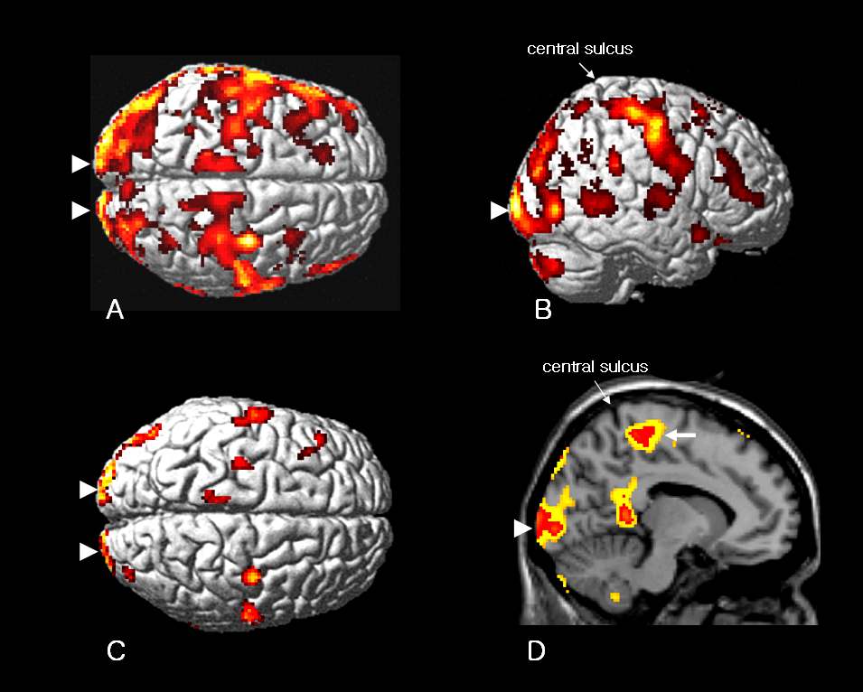 그림 8. 뇌성마비에서의 GABA-A 수용체 변화 (LeeJD et al., Neuroimage, 2007)