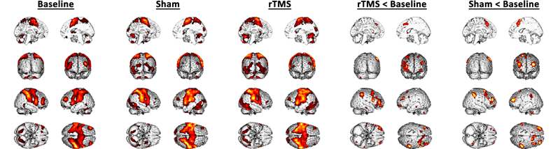 그림 25. Mean_ZR의 분포: 왼쪽부터 One-Sample T-test (Baseline, Sham, rTMS), Paired sample T-test (rTMS < Baseline, Sham < Baseline). 각각의 그림은 corrected FDR < 0.05에서 얻었음