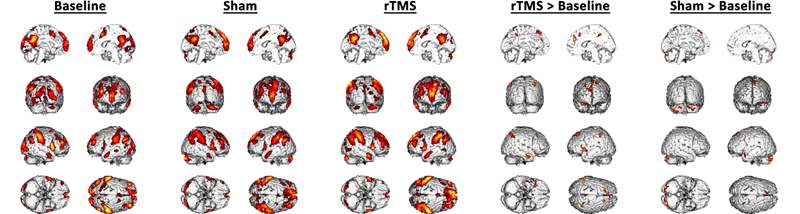 그림 26. Total Count의 분포: 왼쪽부터 One-Sample T-test (Baseline, Sham, rTMS), Paired sample T-test (rTMS < Baseline, Sham < Baseline). 각각의 그림은 corrected FDR < 0.05에서 얻었음