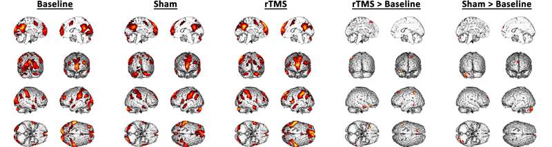 그림 27. Hemi Count의 분포: 왼쪽부터 One-Sample T-test (Baseline, Sham, rTMS), Paired sample T-test (rTMS < Baseline, Sham < Baseline). 각각의 그림은 corrected FDR < 0.05에서 얻었음.