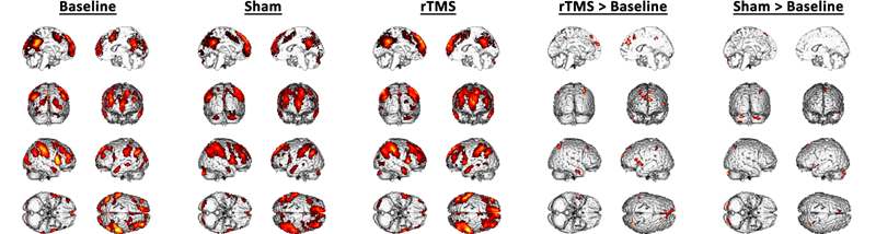 그림 28. Ipsi Count의 분포: 왼쪽부터 One-Sample T-test (Baseline, Sham, rTMS), Paired sample T-test (rTMS < Baseline, Sham < Baseline). 각각의 그림은 corrected FDR < 0.05에서 얻었음.