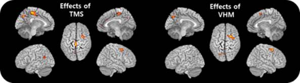 그림 31. 우측 주 운동영역을 single pulse TMS로 자극하였을 때와 VHM 수행하였을 때 신경 활성화 패턴 맵