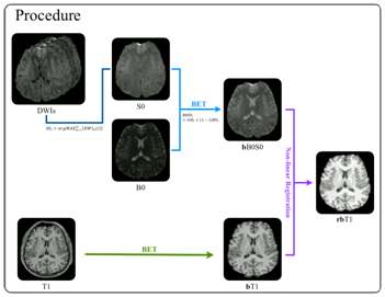 그림 36. B0S0 영상과 비선형 정합기법을 이용한 DWI와 T1 강조 영상 정합의 절차. S0: 확산강조영상들로부터 얻은 S0 영상, B0: B0 영상, bB0S0: 대뇌적출 처리 (BET)를 거친 B0S0 영상, T1: T1 강조 영상, bT1: 대뇌적출 처리를 거친 T1 영상, rbT1: B0 영상에 정합되어진 bT1 영상