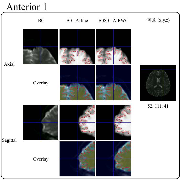 그림 37. 전두엽에서의 두방법의 결과 차이. 십자선은 B0 영상과 비교하여 각 정합방법의 결과가 차이나는 부분을 표시함. Overlay 영상은 B0영상위에 각 정합방법의 결과들이 올려짐.