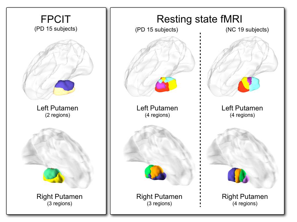 그림 56. FPCIT-PET 과 rs-fMRI 등의 복합기능뇌영상을 이용한 putamen 기능적 분할 연구 결과
