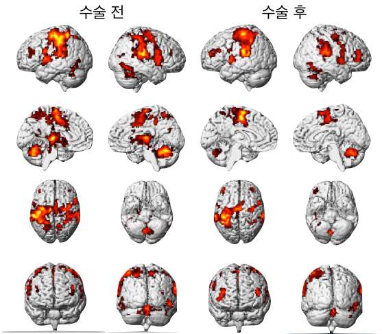그림 64. 과제 수행시 뇌의 활성화 패턴
