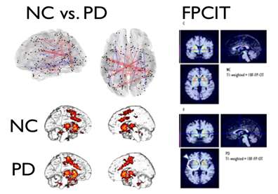 그림 65. FPCIT결과 putamen영역에서 감소된 부분이 기능적연결성 결과에서 유사하게 발견되었음