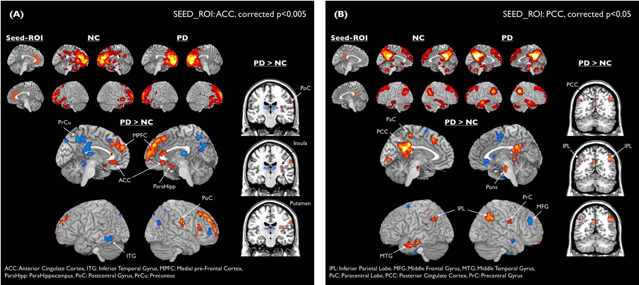 그림 69 Anterior / Posterior Cingulate Cortex(ACC/PCC)를 시드로 한 대뇌 기능적 연결성 분석 결과