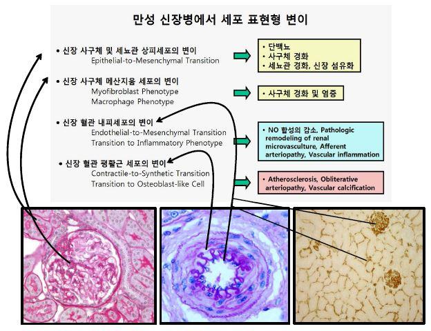 만성신장병에서 세포 표현형 변이의 spectrum 및 의의