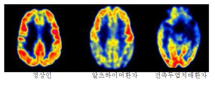 그림1. 전측두엽 치매 (Frontotemporal dementia:FTD) 환자의 FDG-PET/CT 영상.