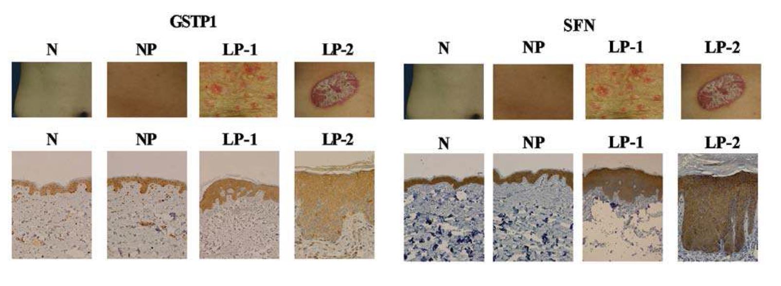 그림 12. lesional psoriatic skin에서 SFN, GSTP1과 PRDX2의 발현