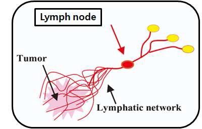 암에서 뻗어나간 감시림프절