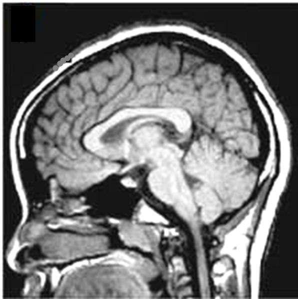 뇌 CT 영상