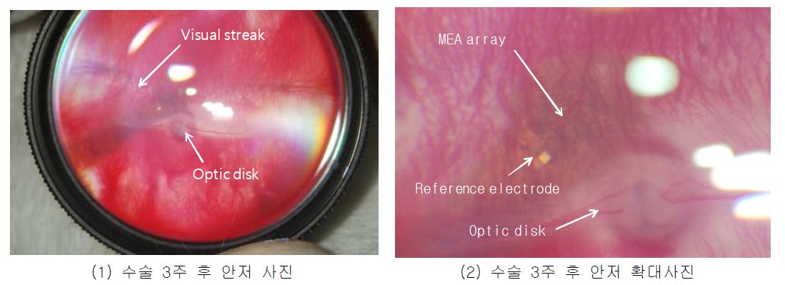 안저 사진 촬영 결과