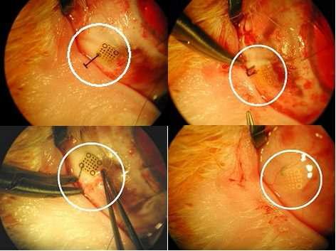 Si 망막못을 이용하여 토끼 안구 바깥쪽 공막에 신경전극을 고정하는 수술
