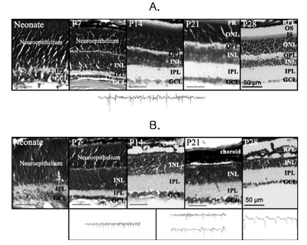 정상 망막 (A)과 변성 망막 (B)의 조직학적 (위), 망막파형 기록 (아래)의 차이점.